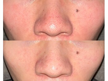 ル シーニュ/毛穴エクストラクション2回