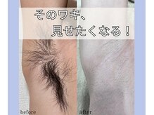 ベルミーランド 浜松天王/脱毛Before→After