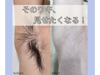 ベルミーランド 浜松天王/脱毛Before→After