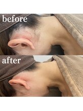 ミノア 熊本店(MINOA)/うなじ脱毛◆ビフォーアフター