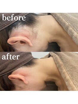 ミノア 熊本店(MINOA)/うなじ脱毛◆ビフォーアフター