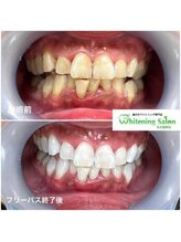 ホワイトニングサロン 名古屋駅店/【ホワイトニング施術例】