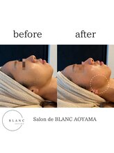 サロン ド ブラン アオヤマ(Salon de BLANC AOYAMA)/BLANC式小顔/水艶肌