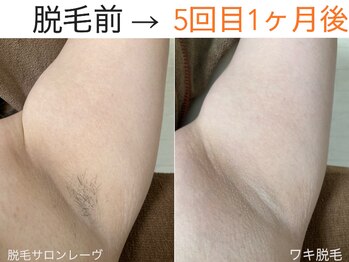 レーヴ/自己処理要らずで毛穴レスに♪