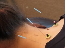 きわみ鍼灸整骨院 博多院/首肩の痛みに