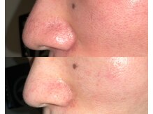 ル シーニュ/毛穴エクストラクション