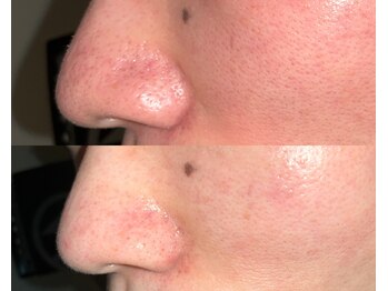 ル シーニュ/毛穴エクストラクション