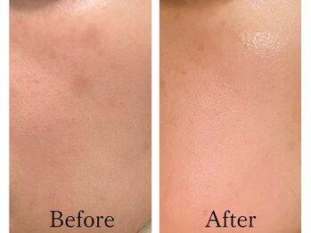 リノア 柏(Lino'a)/色素ケアが叶う再生ピーリング