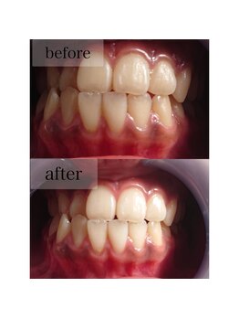 ココビューティー(COCOBEAUTY)/セルフホワイトニング