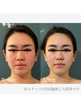 クリア(CLEAR)/小顔美整顔