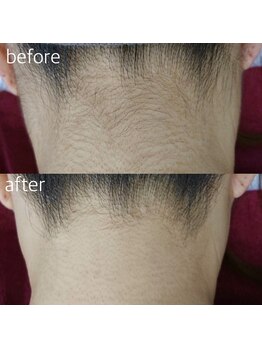 スイッチプラス(switch plus)/-うなじ脱毛-