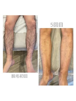 ミスト(MISTO)/【メンズ脱毛】