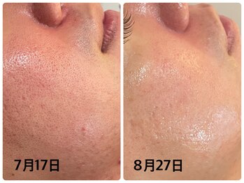 デューン 蕨店(Dune)/今話題のハーブピーリング★