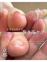 アイル(isle)/【巻き爪でお悩み】3ヶ月後経過