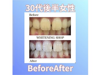 ホワイトニングショップ 西原店/30代後半女性☆BeforeAfter