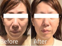 藍/レモンボトル×プラズマ