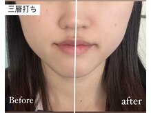 ライム 武蔵小杉(LIME)/自社痩身で即実感｜小顔ケア