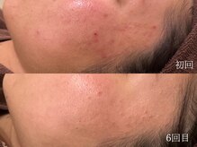 ウォーム(warm)/肌質改善/岡山/フェイシャル