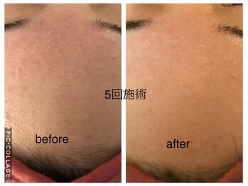 ラ ルーチェ(La Luce)/ハーブピーリング