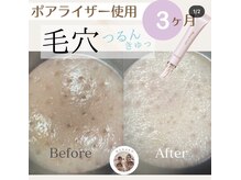 メナードフェイシャルサロン 宮の沢/ポアライザー使用前後