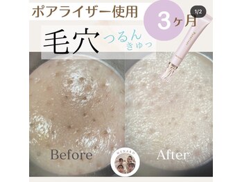 メナードフェイシャルサロン 宮の沢/ポアライザー使用前後