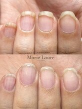 マリーロール 梅田店(Marie Laure)/自爪育成/深爪矯正/ネイルケア