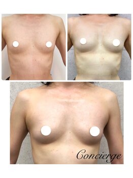 ルフルリール(Refleurir)/◆バストアップ症例/育乳◆