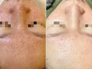 ピブ(PIBU)/脂漏性症例/ハーブピーリング