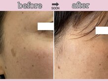 サクラ スパ(SAKURA SPA)/フェイシャル『ADSプログラム』