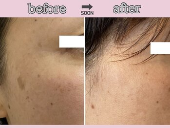 サクラ スパ(SAKURA SPA)/フェイシャル『ADSプログラム』