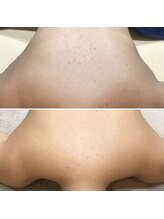 ヴィヴィ(ViVi)/HAAB REPRO　背中ハーフ