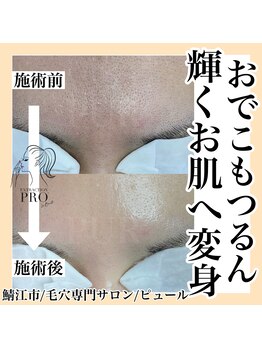 ピュール 鯖江店(PUR)/毛穴サロン/毛穴ケア/毛穴洗浄