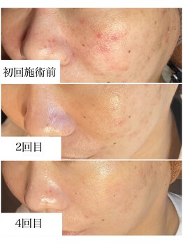 ブラックボックス(BLACK BOX)/ハーブピーリング3回+陶肌ピール