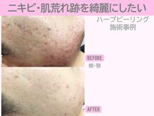 ぷるるんエステ/ハーブピーリング/ピーリング