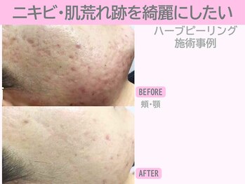 ぷるるんエステ/ハーブピーリング/ピーリング