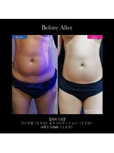 アルビ(ARuBi)/冷え固まった脂肪にアプローチ◎