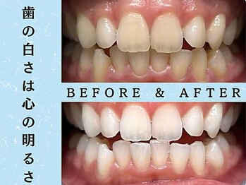 ホワイトニングショップ 浦和店/ホワイトニングビフォーアフター