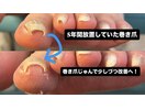5年放置した巻き爪少しずつ改善