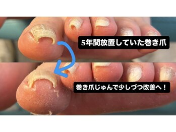 5年放置した巻き爪少しずつ改善