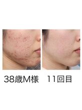 ビルーチェ(BELUCE)/プラズマフェイシャル