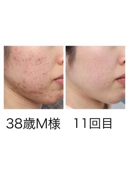 ビルーチェ(BELUCE)/プラズマフェイシャル