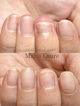 マリーロール 淀屋橋本店(Marie Laure)/深爪矯正/自爪風/自爪育成
