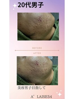 アレーズファイブフォー(A’LAISE54)/メンズ陶肌トリートメント