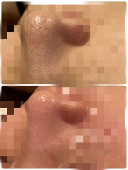 クイーンズ ピュア 長崎店(Queen's Pure)/フェイシャル毛穴洗浄+小顔