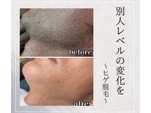 レジェンド 鹿児島店の雰囲気（当店人気No.1の髭脱毛。学生～忙しい大人の方こそ始めてほしい♪）