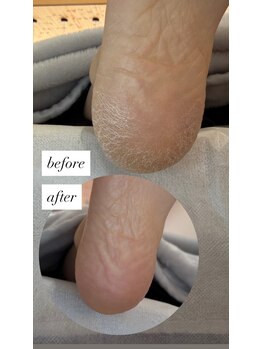 フットミー(foot mii)/１回目