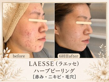 エスポワール(espoir)/皮脂が多いニキビ肌改善