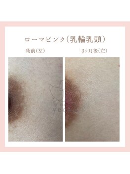 ヨウン 福岡天神(yeoun)/ローマピンク福岡/メラニンケア