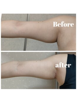 痩身 脱毛専門サロン 椿/脂肪冷却/キャビ/ラジオ波