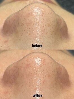 アットウィル 志木店(at will)/毛穴洗浄BeforeAfter